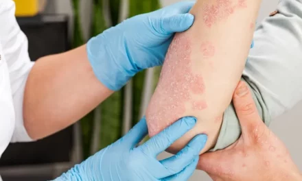 สะเก็ดเงิน (Psoriasis) มีวิธีการรักษาอย่างไร?